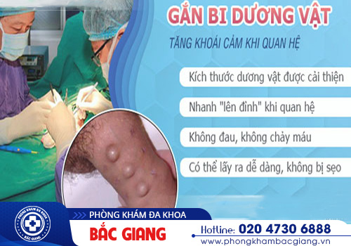 Chi phí gắn bi dương vật hiện nay