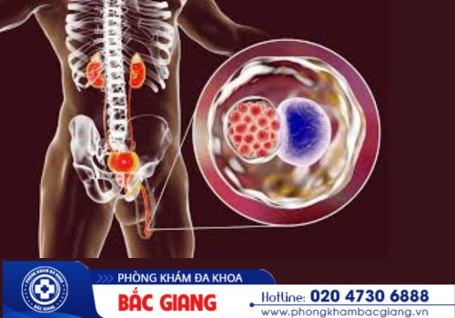 Nhiễm khuẩn tiết niệu