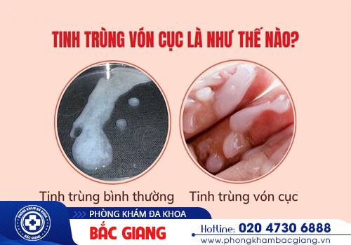 cách chữa tinh trùng bị vón cục
